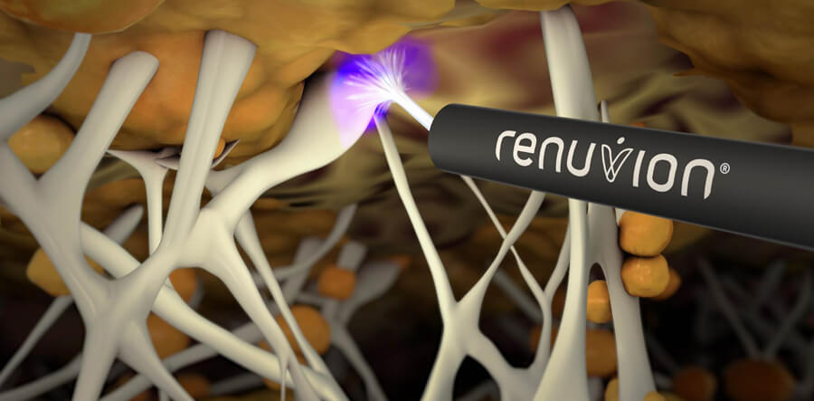 https://leandroalmeidaplastica.agenciaflex.com/wp-content/uploads/2021/02/renuvion-lipo-cirurgia-plastica-teresina-leandro-almeida-1.jpg